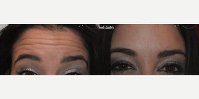Case 5340 - Botox
