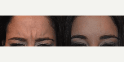 Case 5341 - Botox