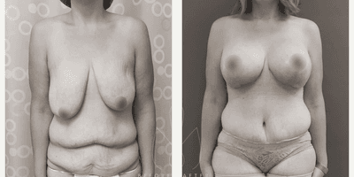 Case 560 - Woman treated with Tummy Tuck