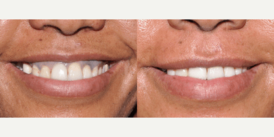 Case 5607 - Botox for Excessive Gum Show with Smiling (Gummy Smile)