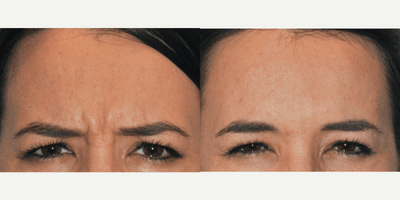 Case 5608 - Botox for Glabella (Frown) Lines Between Eyebrows