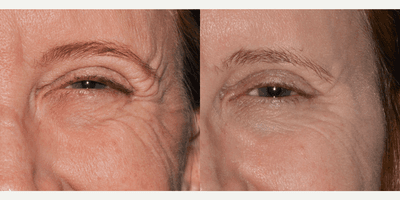 Case 5609 - Botox for Eyelid Smile Lines (Crow's Feet)