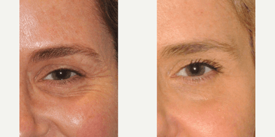 Case 5611 - Botox for Eyelid Smile Lines (Crow's Feet)