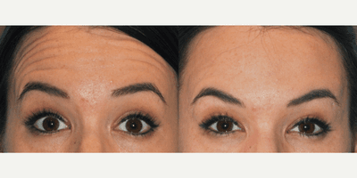 Case 5612 - Botox for Forehead Lines