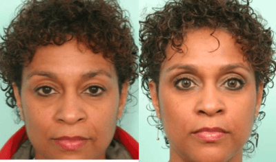 Case 5987 - 35-44 year old woman treated with Botox and fillers in the lower eyelids