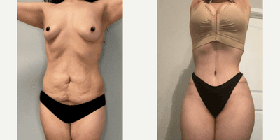 Case 61 - Woman treated with Tummy Tuck