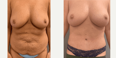 Case 611 - 25-34 year old woman treated with Tummy Tuck