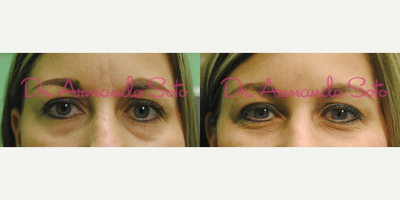 Case 6385 - Woman treated with Botox