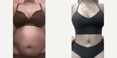 Case 640 - Woman treated with Tummy Tuck