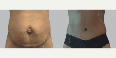 Case 641 - Woman treated with Tummy Tuck