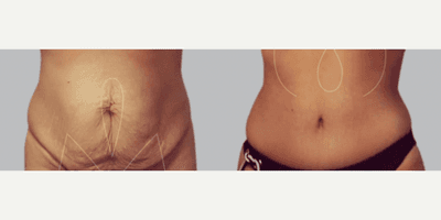 Case 642 - Woman treated with Tummy Tuck