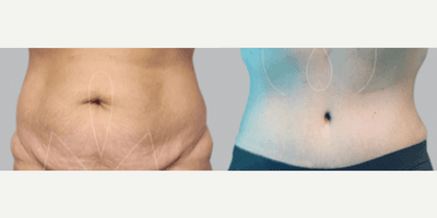 Case 643 - Woman treated with Tummy Tuck