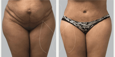 Case 644 - Woman treated with Tummy Tuck