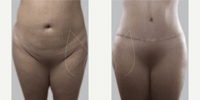 Case 645 - Woman treated with Tummy Tuck