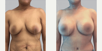 Case 656 - Woman treated with Tummy Tuck