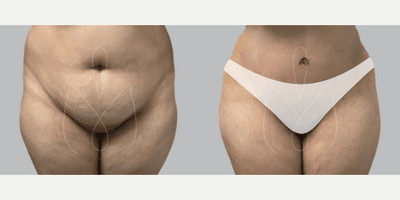 Case 657 - Woman treated with Tummy Tuck