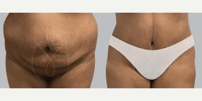 Case 658 - Woman treated with Tummy Tuck