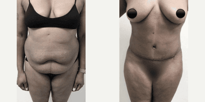 Case 659 - Woman treated with Tummy Tuck