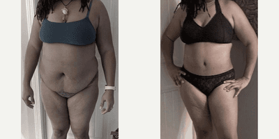 Case 660 - Woman treated with Tummy Tuck