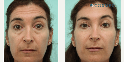 Case 6607 - Botox & Fillers