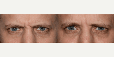 Case 6608 - Male Glabellar Botox