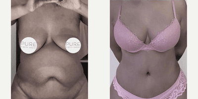 Case 661 - Woman treated with Tummy Tuck