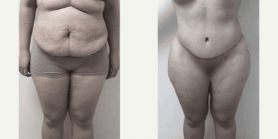 Case 662 - Woman treated with Tummy Tuck