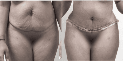 Case 663 - Woman treated with Tummy Tuck