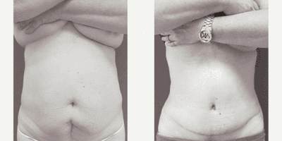 Case 664 - Woman treated with Tummy Tuck