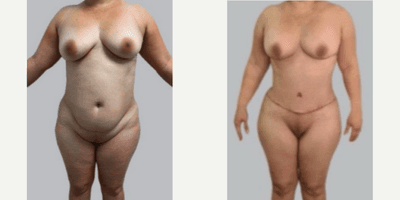 Case 665 - Woman treated with Tummy Tuck