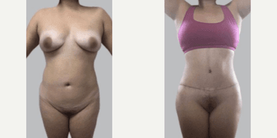 Case 666 - Woman treated with Tummy Tuck