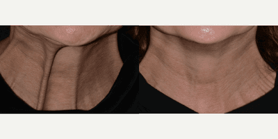 Case 6753 - Botox for Neck Platysma Bands
