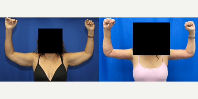 Case 6917 - 45-54 year old woman treated with Arm Lift