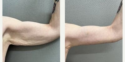 Case 6955 - 45-54 year old woman treated with Arm Lift