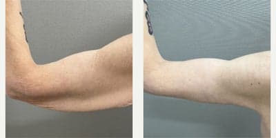 Case 6956 - 45-54 year old woman treated with Arm Lift