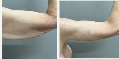 Case 6957 - 45-54 year old woman treated with Arm Lift