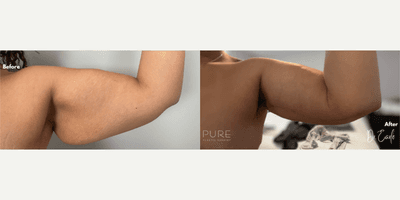 Case 6962 - Woman treated with Arm Lift