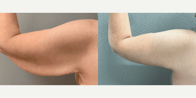 Case 6964 - 45-54 year old woman treated with Arm Lift