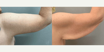 Case 6965 - 45-54 year old woman treated with Arm Lift