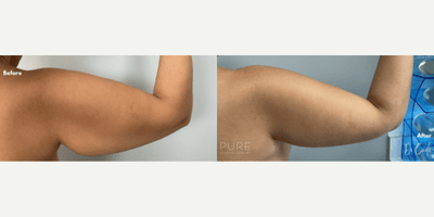 Case 6968 - Woman treated with Arm Lift