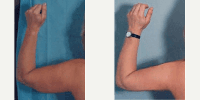Case 6974 - Woman treated with Arm Lift