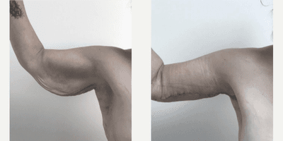 Case 7020 - Woman treated with Arm Lift