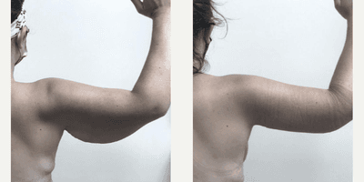 Case 7021 - Woman treated with Arm Lift