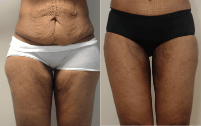 Case 7129 - 35-44 year old woman treated with Thigh Lift