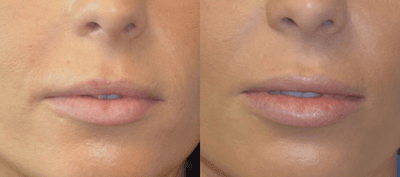 Case 7149 - 25-34 year old woman treated with Lip Implants