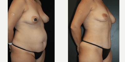 Case 7157 - 35-44 year old woman treated with Tummy Tuck, Liposuction, Lip Implants