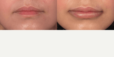 Case 7182 - 35-44 year old woman treated with Lip Implants