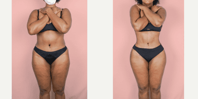Case 7405 - 25-34 year old woman treated with Liposuction, Brazilian Butt Lift
