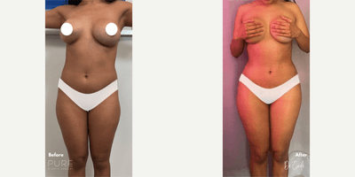 Case 7407 - Woman treated with Brazilian Butt Lift
