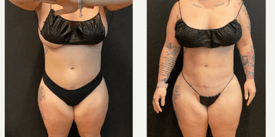 Case 7408 - 35-44 year old woman treated with Brazilian Butt Lift, Abdominal Etching